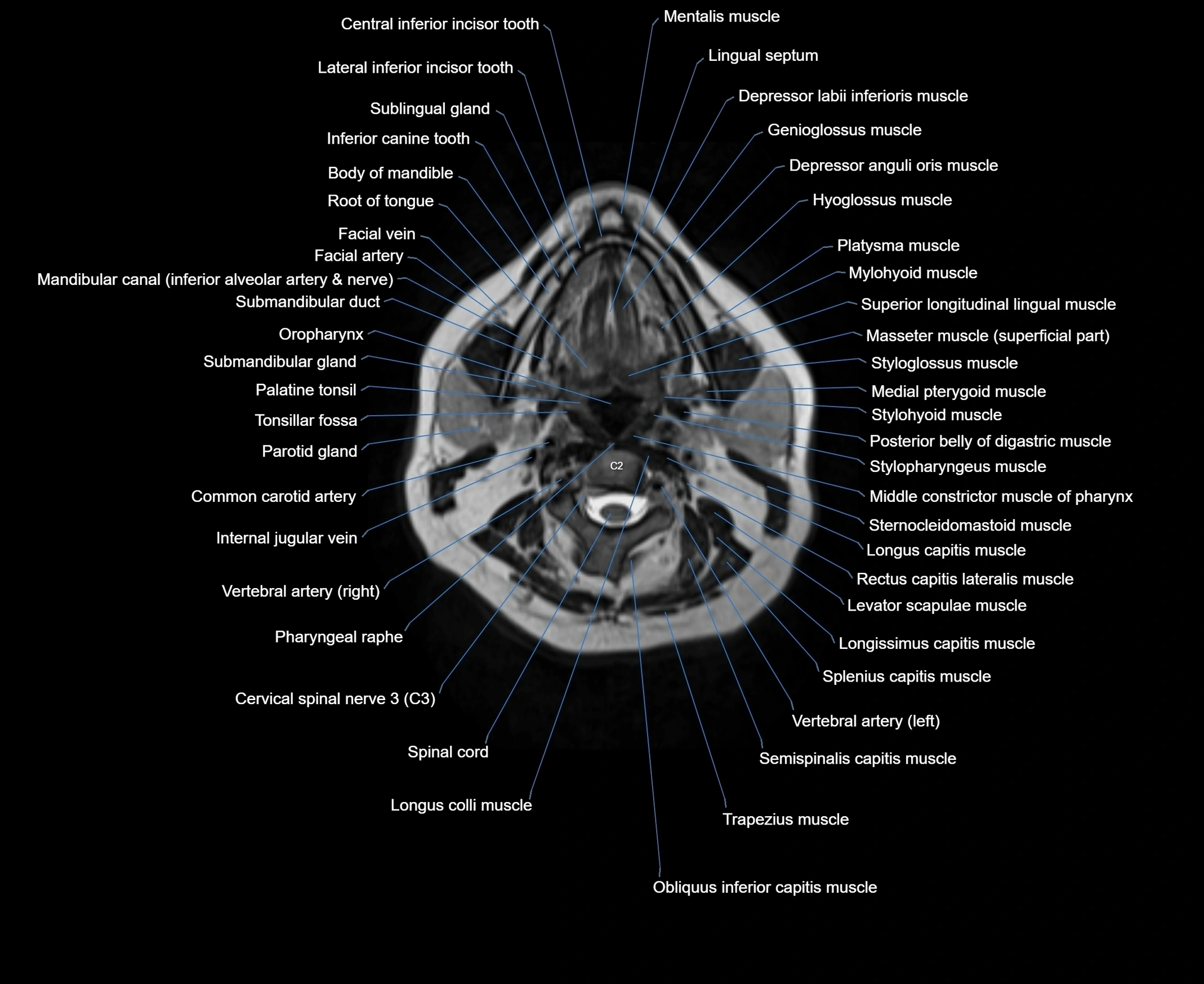 MRI Neck 3D labelled cross section anatomy axial 3t image-00001-00039.webp